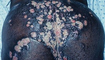herpes-around-ass.jpg