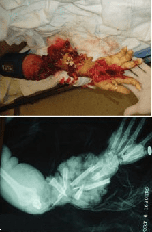 handinjury.PNG