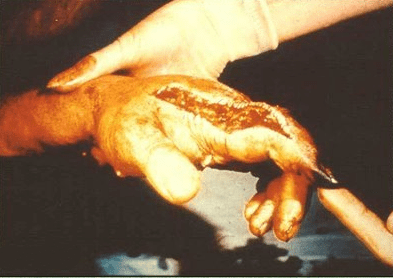 handinjury1.PNG