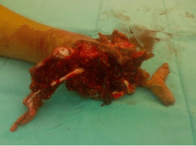 handinjury2.PNG