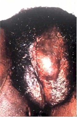 Name:  hematoma250.jpg
Views: 19842
Size:  31.9 KB