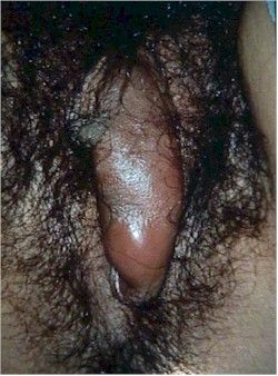 Name:  Abscess250.jpg
Views: 19845
Size:  33.4 KB