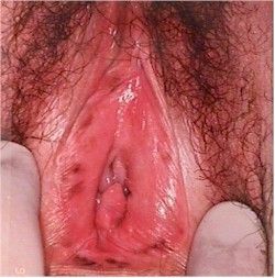 Name:  melanosis250.jpg
Views: 20398
Size:  23.5 KB