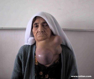 goiter101.jpg