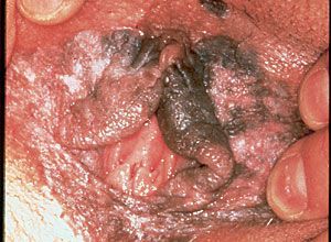 vagina cancer (6).jpg