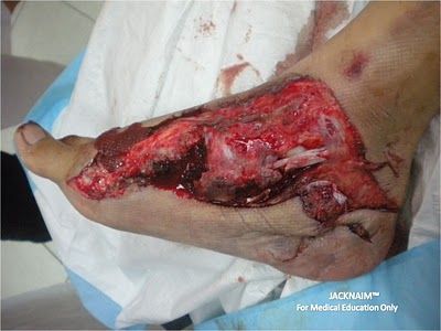 Crush Injuries and Rhabdomyolysis.jpg