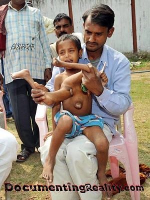 india-limb-boy-02.jpg