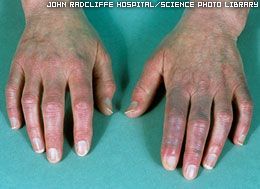 raynauds-blue-hands_default.jpg