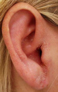 otitis-externa-fissuring-conchac200pxw.jpg