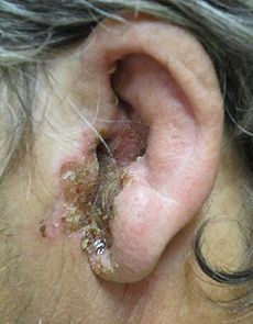 Otitis-Externa-or-Swimmers-Ear.JPG