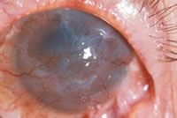 04_01_stevens-johnson_syndrome2x.jpg
