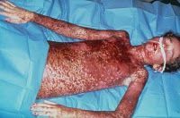 Steven_Johnson_SYndrome_Mbah_DUkun_Bagong_2.jpg