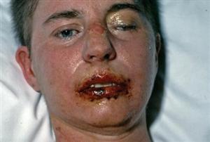 stevens-johnson-syndrome-5.jpg