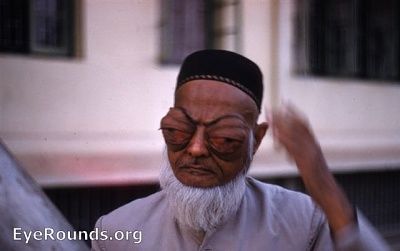 bilateral-orbital-disease-lymphomata.jpg