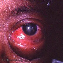 retinoblastoma53.jpg