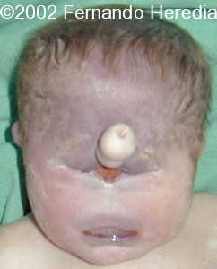 cyclopia.jpg