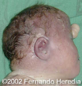 cyclopia side.jpg