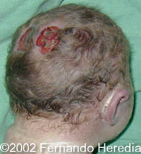 cyclopia back.jpg