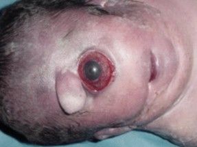 SINDROME DE PATAU.jpg