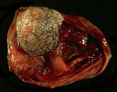 med-teratomas.jpg