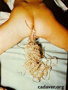 roundworms-th.jpg