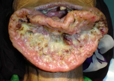 mouth cancer.jpg