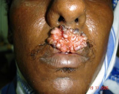 mouth cancer1.jpg