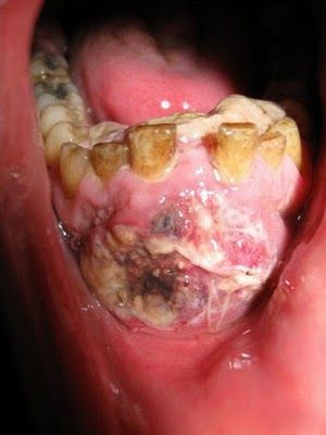 mouth cancer2.jpg