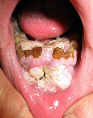 mouth cancer3.jpg