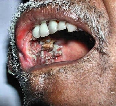 mouth cancer4.jpg