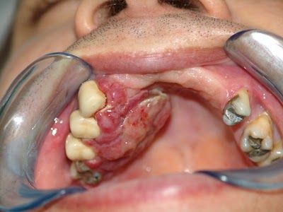 mouth cancer5.jpg