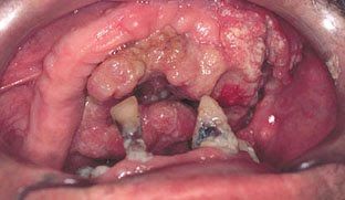 mouth cancer6.jpg