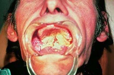 mouth cancer7.jpg