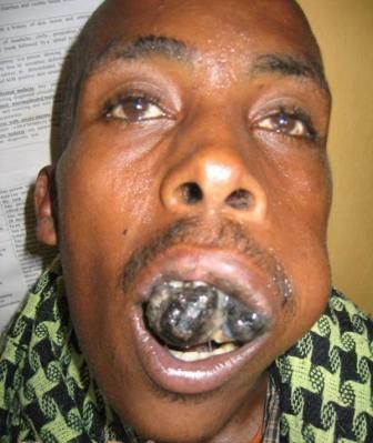 mouth cancer8.jpg