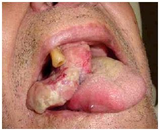 mouth cancer10.jpg