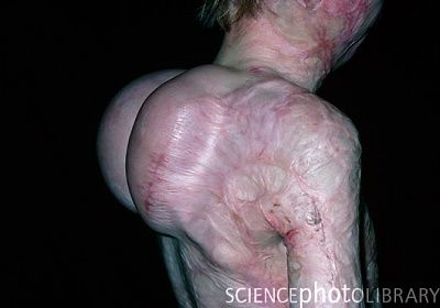 m335102-tissue_expanders_for_skin_grafting_in_burns_victim-spl.jpg