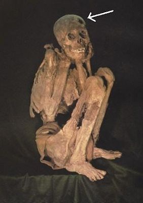 historic-trepanation-1.jpg