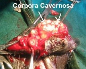 penis-cancer-4-300x241.jpg