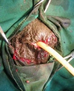 penis-cancer-5-242x300.jpg