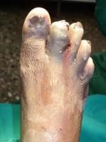 toe-amputation-1_thumbnail.jpg