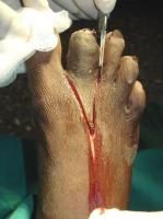 toe-amputation-2_thumbnail.jpg