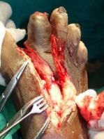 toe-amputation-3_thumbnail.jpg