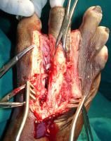 toe-amputation-4_thumbnail.jpg