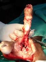 toe-amputation-5_thumbnail.jpg