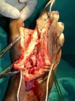 toe-amputation-6_thumbnail.jpg