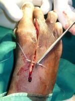 toe-amputation-7_thumbnail.jpg