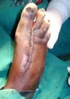 toe-amputation-8_thumbnail.jpg
