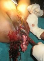 craniotomy-9_thumbnail.jpg