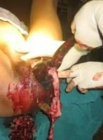craniotomy-10_thumbnail.jpg
