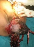 craniotomy-11_thumbnail.jpg